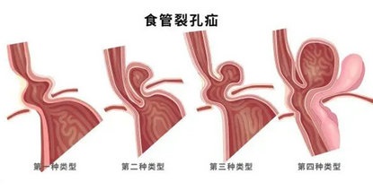 反酸、烧心、上腹胀痛……警惕食管裂孔疝