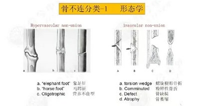 骨不连：骨折背后的“潜伏危机”