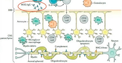 MOGAD，这是什么病？